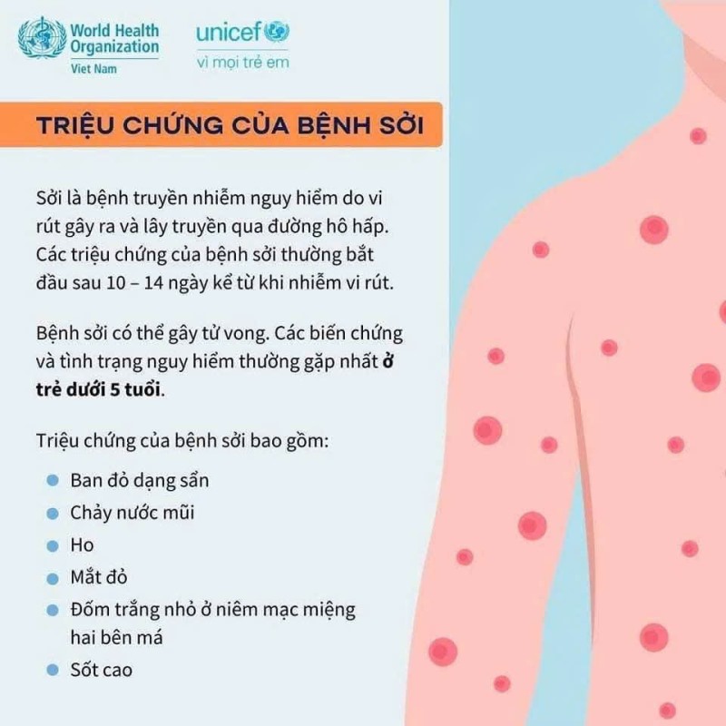 BỆNH SỞI - NHỮNG ĐIỀU BỐ MẸ CẦN BIẾT TRONG MÙA DỊCH